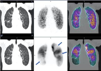 Gallium-68 Ventilation/Perfusion PET-CT and CT Pulmonary Angiography for Pulmonary Embolism Diagnosis: An Interobserver Agreement Study